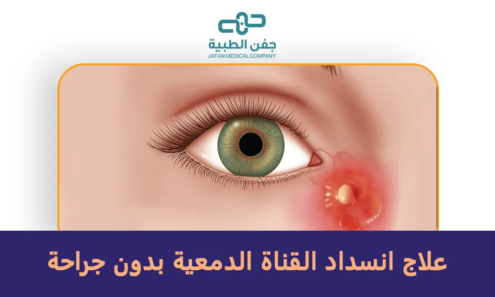 علاج انسداد القناة الدمعية بدون جراحة