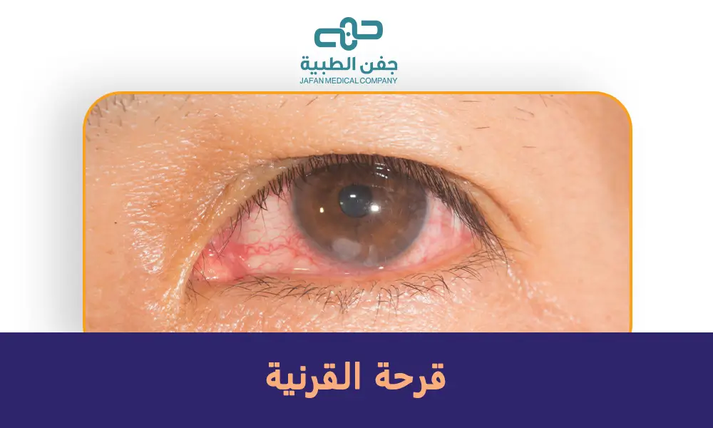 قرحة القرنية