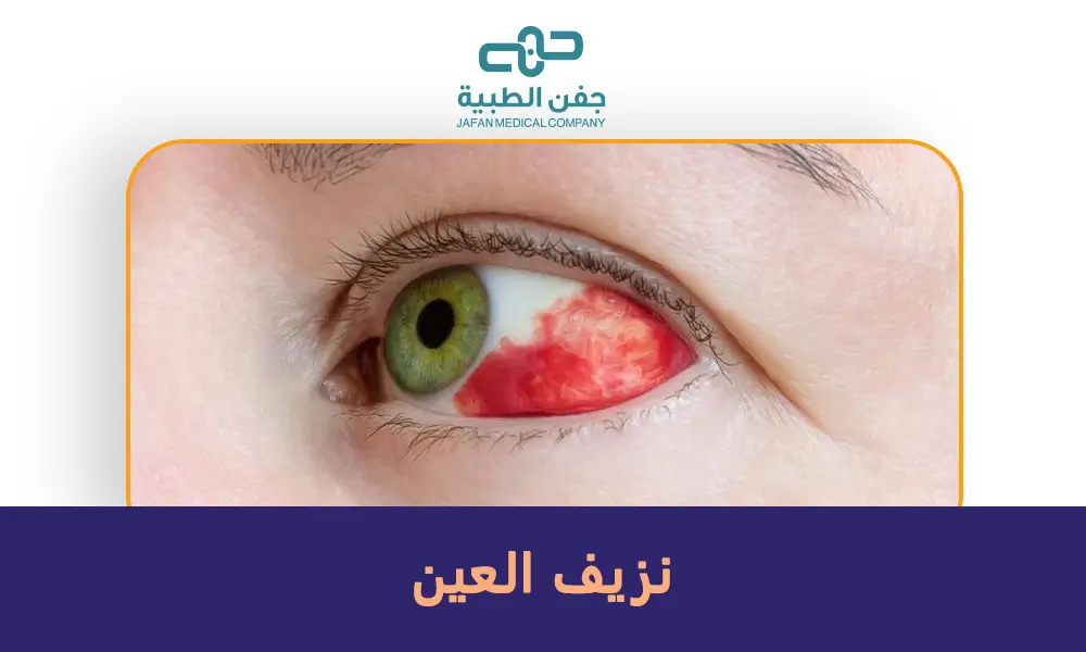 نزيف العين